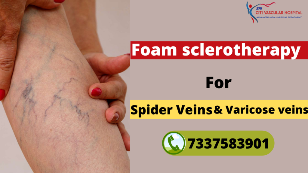 specialist for varicose veins 