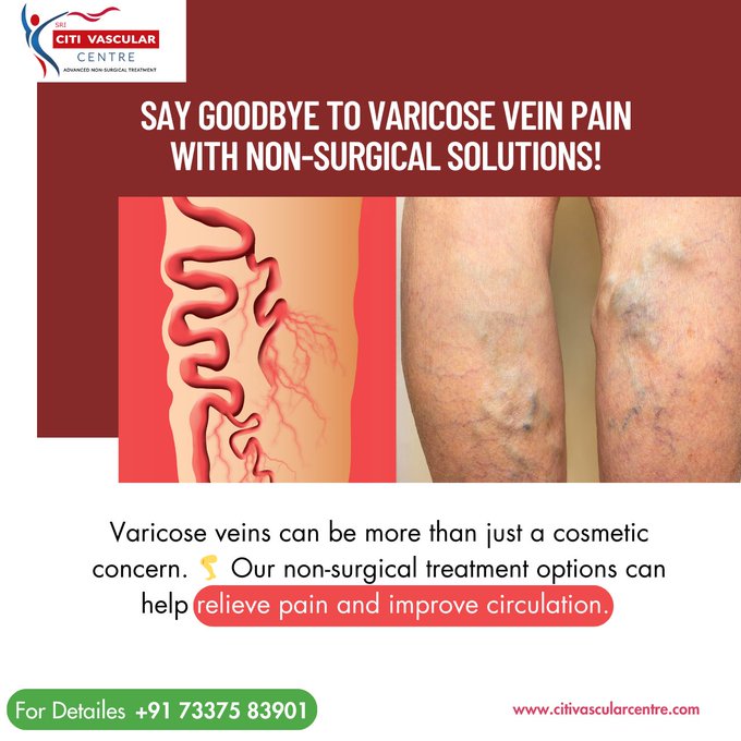 Best hospital for varicose veins treatment in hyderabad 