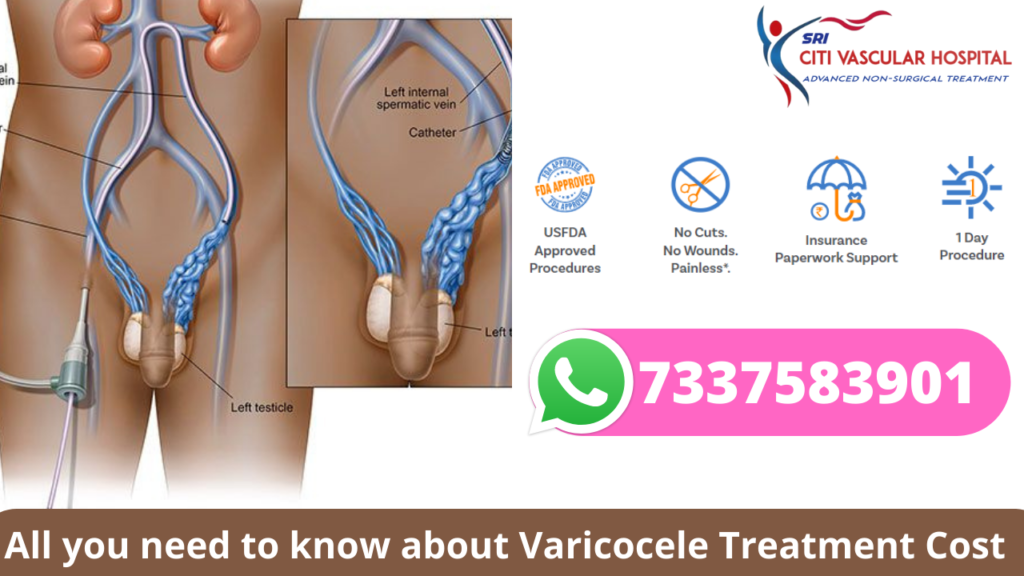 varicocele treatment cost in hyderabad