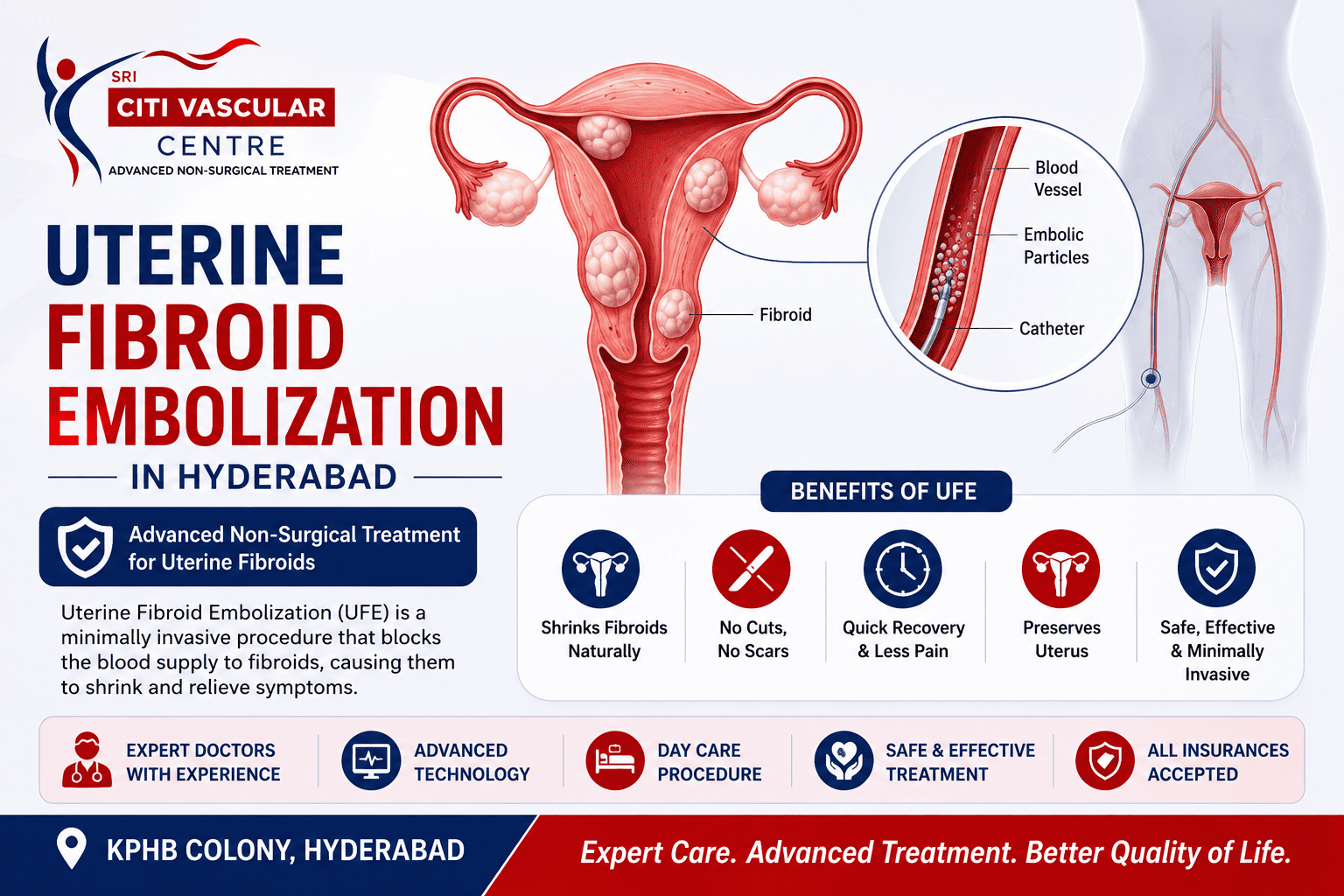 Uterine fibroid embolization in Hyderabad