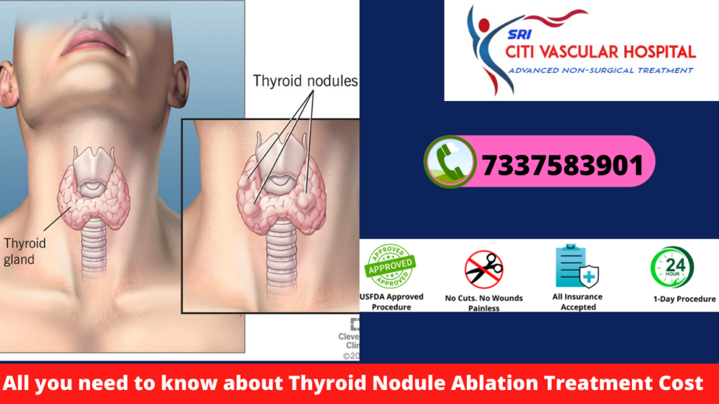 cost of thyroid treatment