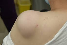 lipoma removal cost in hyderabad