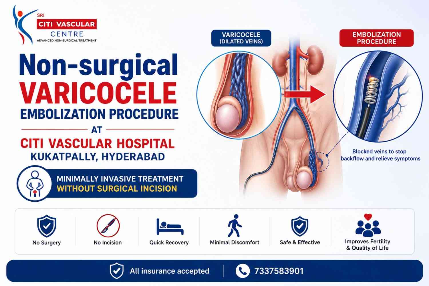 Non-surgical varicocele embolization procedure at Citi Vascular Hospital Kukatpally Hyderabad showing minimally invasive treatment without surgical incision