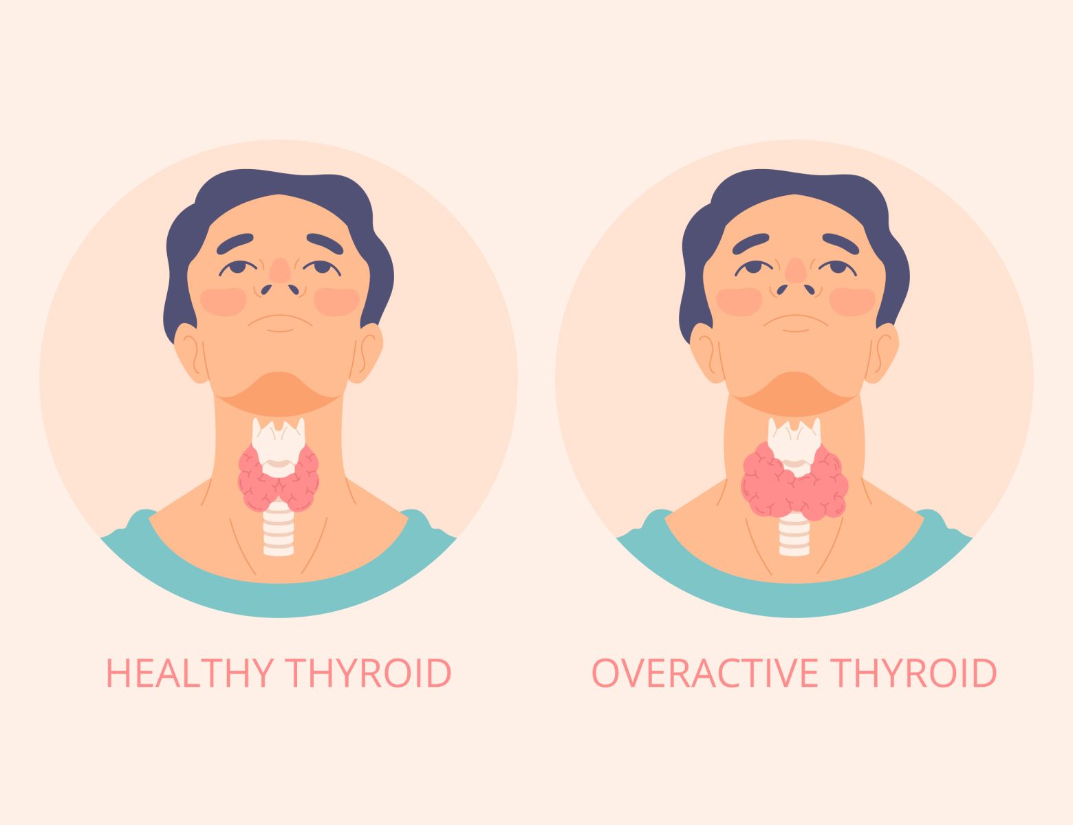thyroid specialist in hyderabad