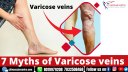 best varicose veins treatment in hyderabad