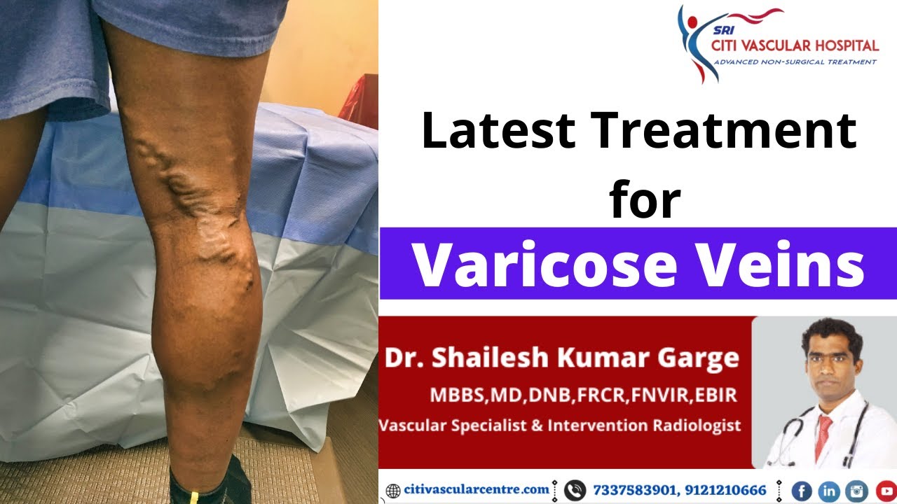best laser treatment for varicose veins in hyderabad