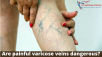 best treatment for varicose veins 