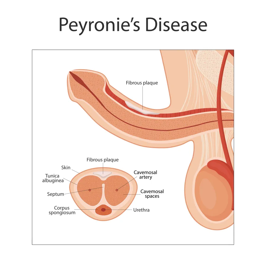 Penile curvature treatment in Hyderabad