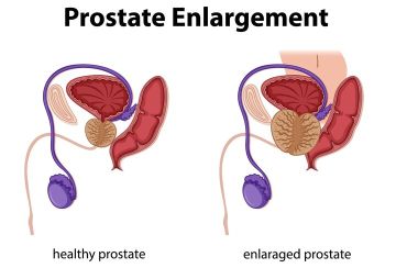 best prostate treatment in hyderabad 