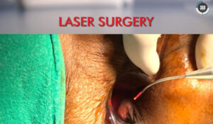 best piles laser surgery in Hyderabad