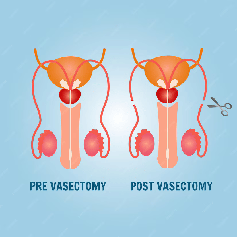 Best Vasectomy Doctor in Hyderabad for Safe Family Planning