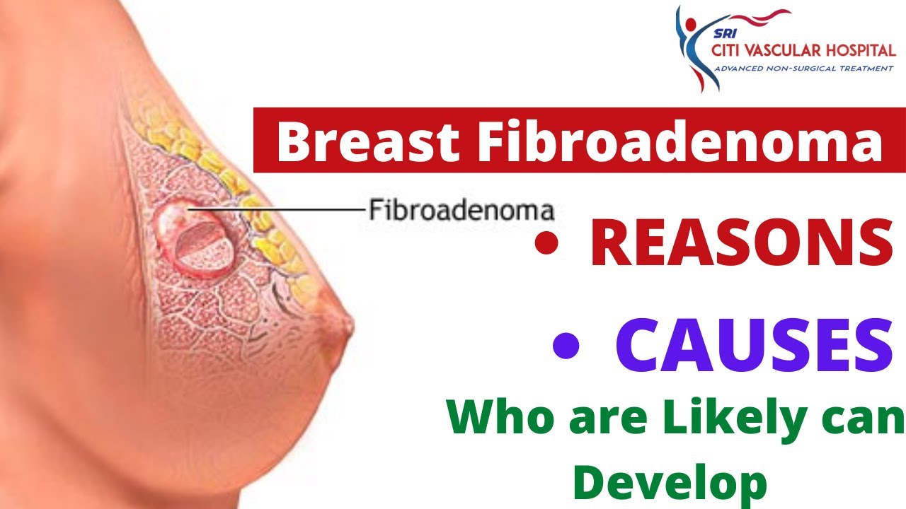 Breast Fibroids treatment near me 