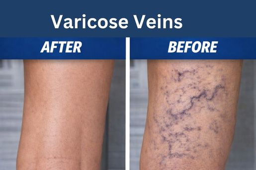 best doctor & hospital for varicose veins in hyderabad