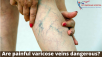 best doctor for varicose veins 
