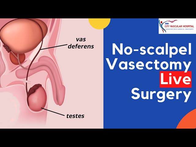 best treatment for vasectomy 