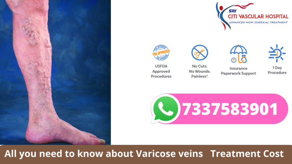 top specialist for varicose veins in hyderabad