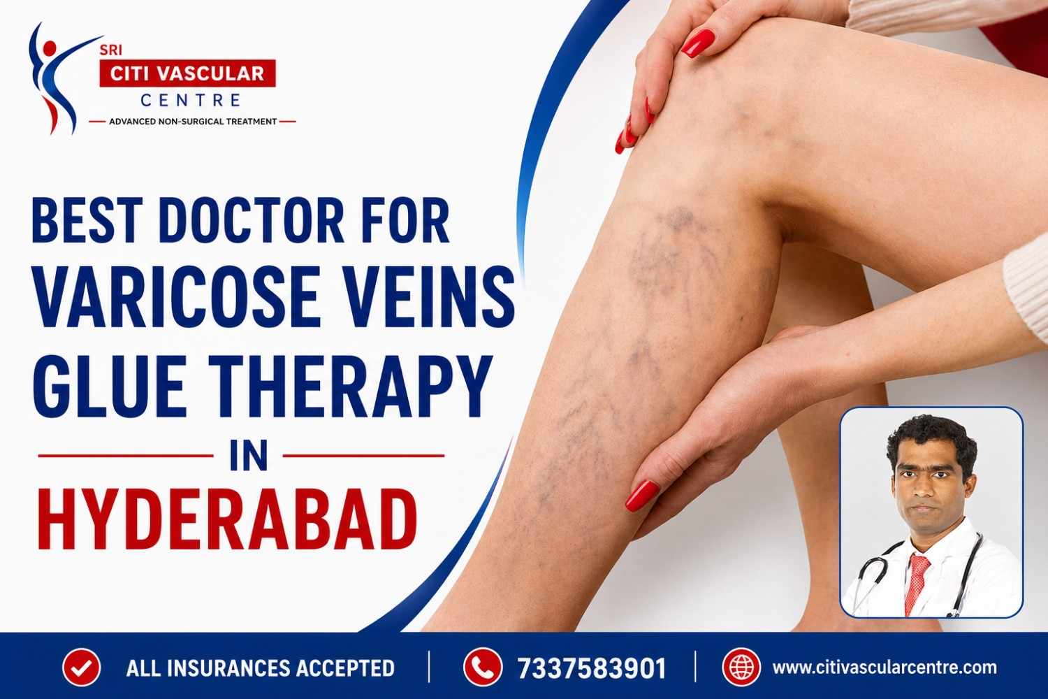 Dr. Shaileshkumar Garge performing VenaSeal cyanoacrylate glue treatment for varicose veins under duplex Doppler ultrasound guidance at Citi Vascular Hospital KPHB Colony Hyderabad 
