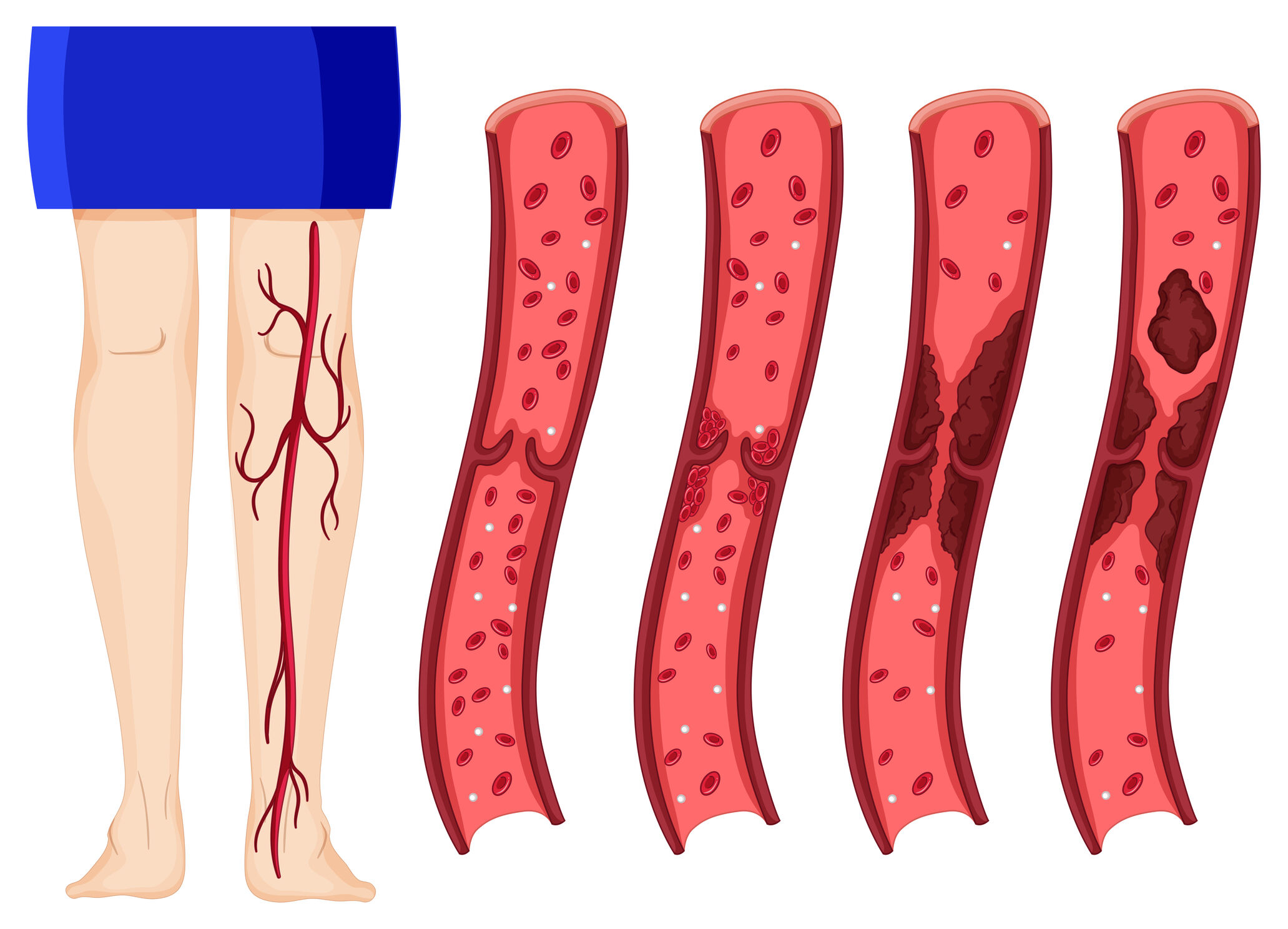 best hospital for varicose veins treatment in Hyderabad