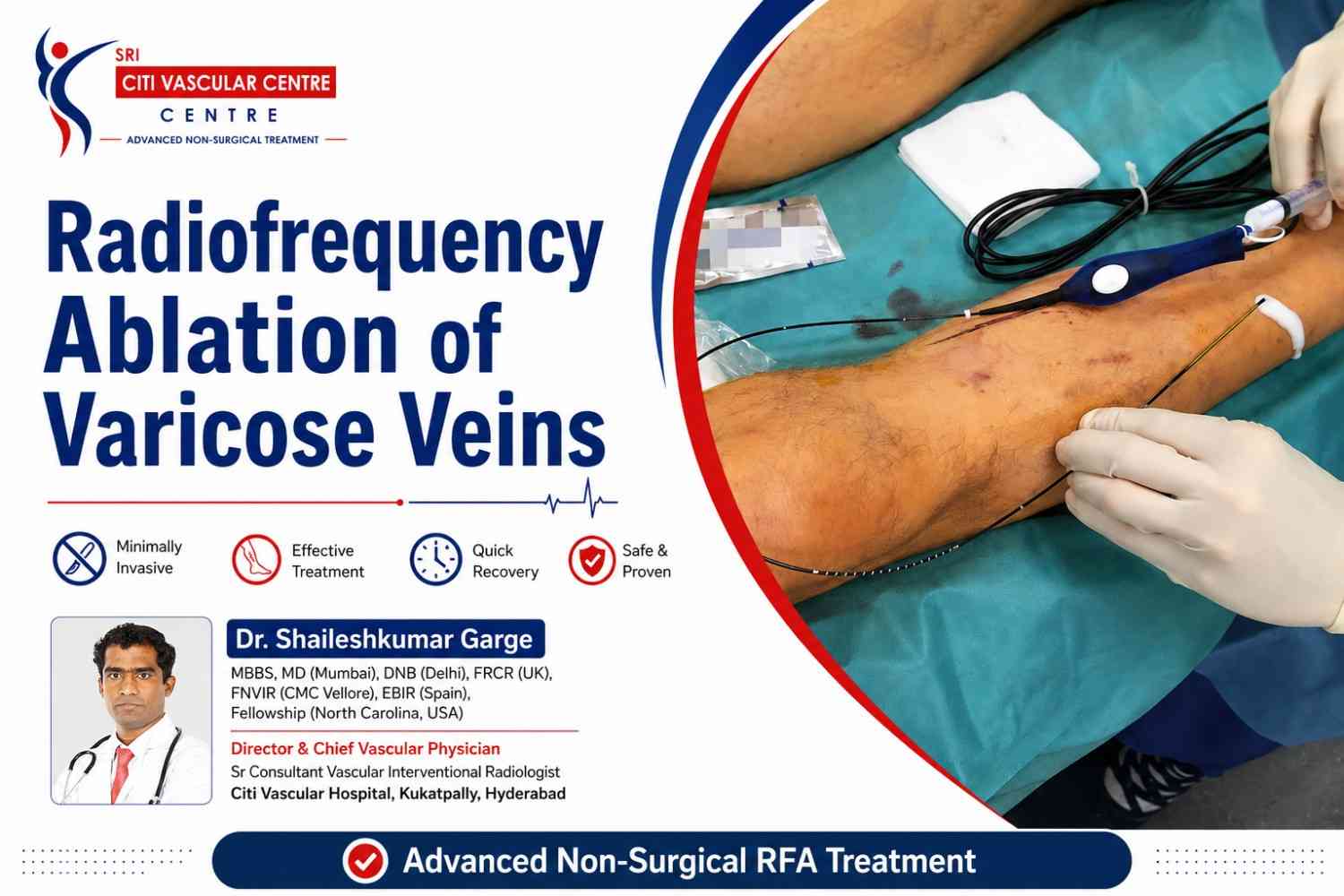 Dr. Shaileshkumar Garge performing radiofrequency ablation RFA treatment for varicose veins under ultrasound guidance at Citi Vascular Hospital KPHB Colony Hyderabad 