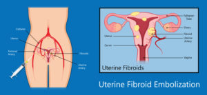 fibroid surgery cost in Hyderabad 