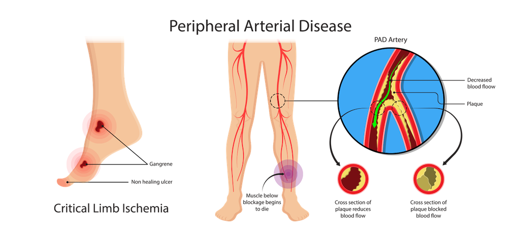  treatment for peripheral artery disease