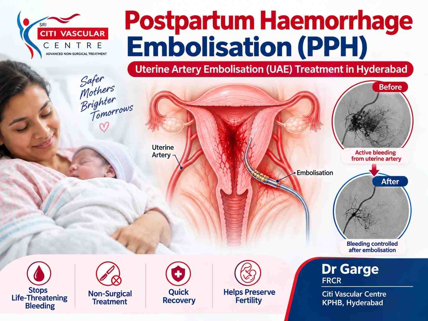 Uterine artery embolisation UAE PPH postpartum haemorrhage fluoroscopy catheter Hyderabad Citi Vascular Centre KPHB
