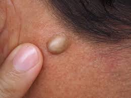 sebaceous cyst removal cost in hyderbad