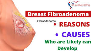 Breast Fibroadenoma 