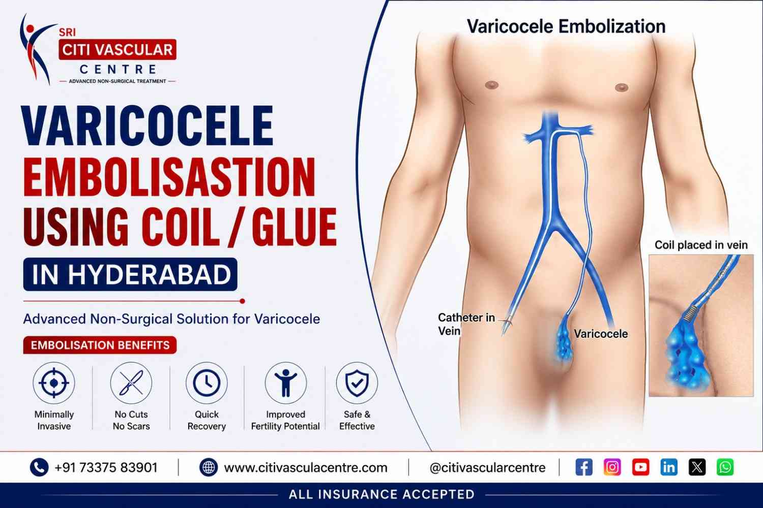 Dr. Shaileshkumar Garge performing varicocele embolization using fluoroscopy guidance at Citi Vascular Hospital Kukatpally Colony Hyderabad — minimally invasive non-surgical treatment