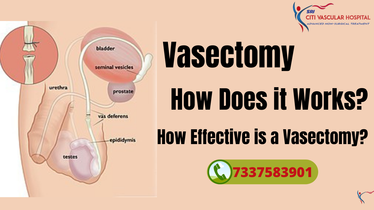 Vasectomy treatment in hyderabad