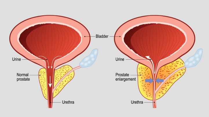 Prostate treatment in Hyderabad 