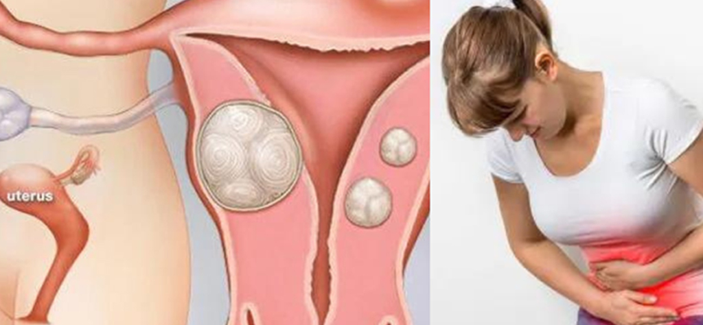 best hospital for fibroids in hyderabad