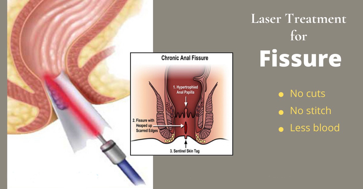 fissure treatment without surgery in hyderabad