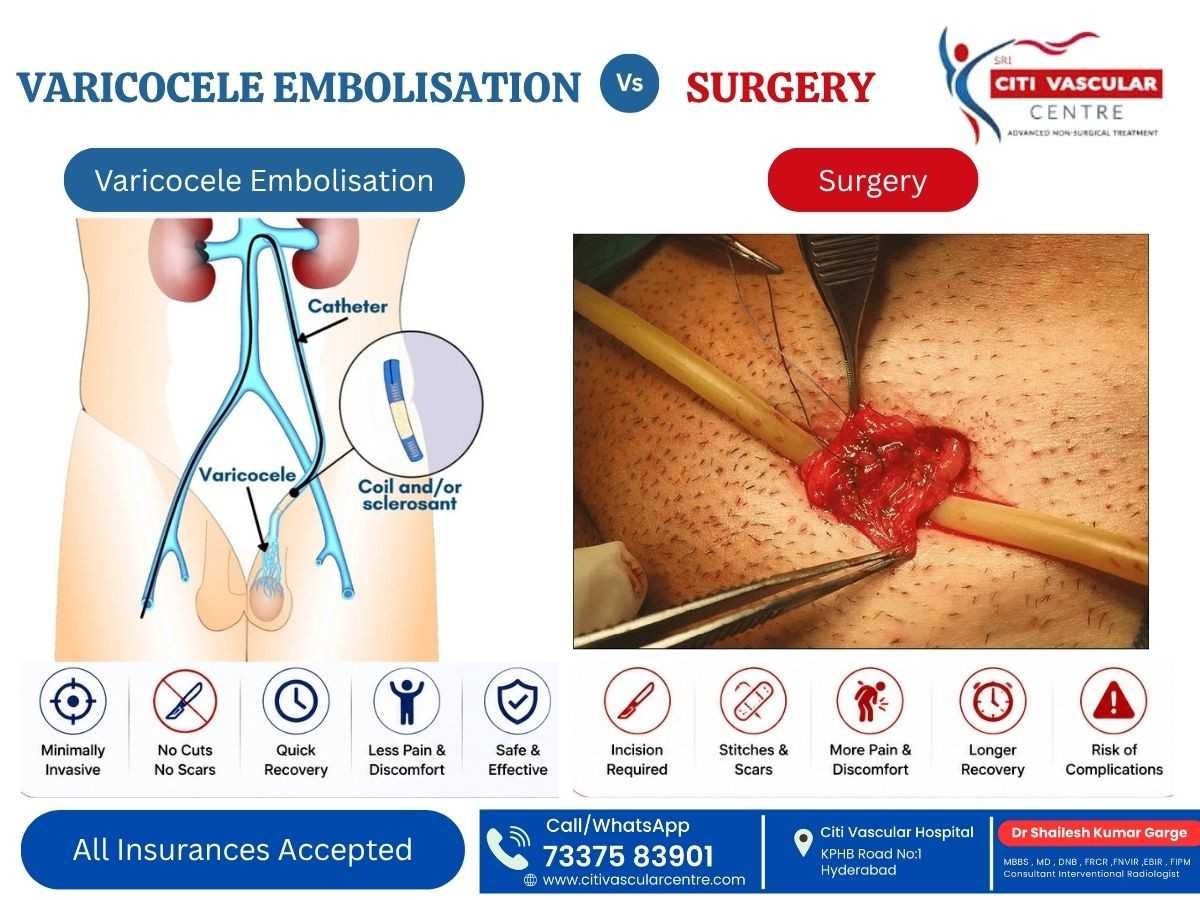 Side-by-side comparison of varicocele surgery and varicocele embolization showing procedure differences, recovery times, and outcomes at Citi Vascular Hospital KPHB Hyderabad 2026
