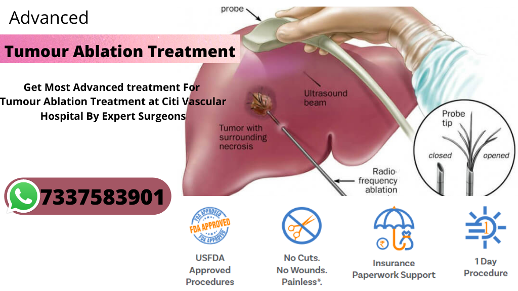 tumor Ablation treatment in Hyderabad