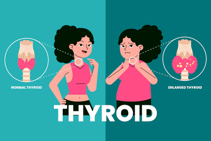 Thyroid nodule treatment in Hyderabad