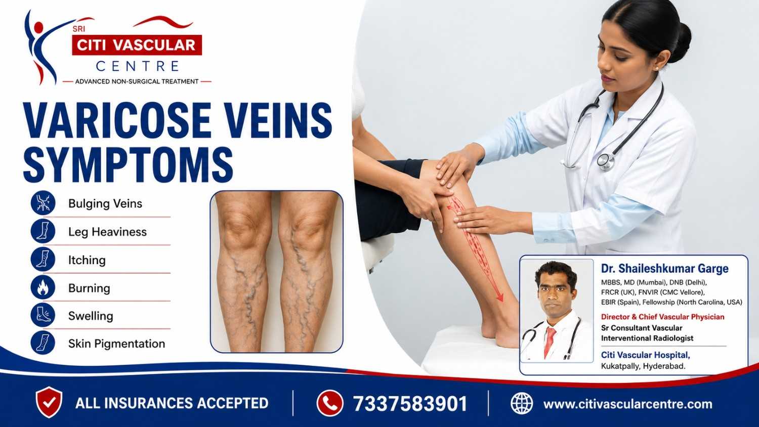 Visible bulging varicose veins with symptoms of leg pain swelling and heaviness explained by Dr Shaileshkumar Garge Hyderabad
