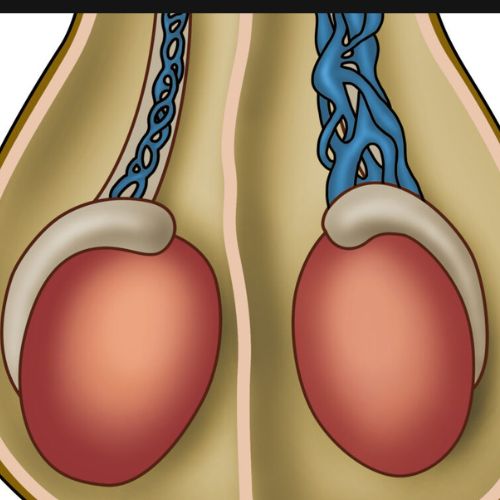 treatment for varicocele in hyderabad
