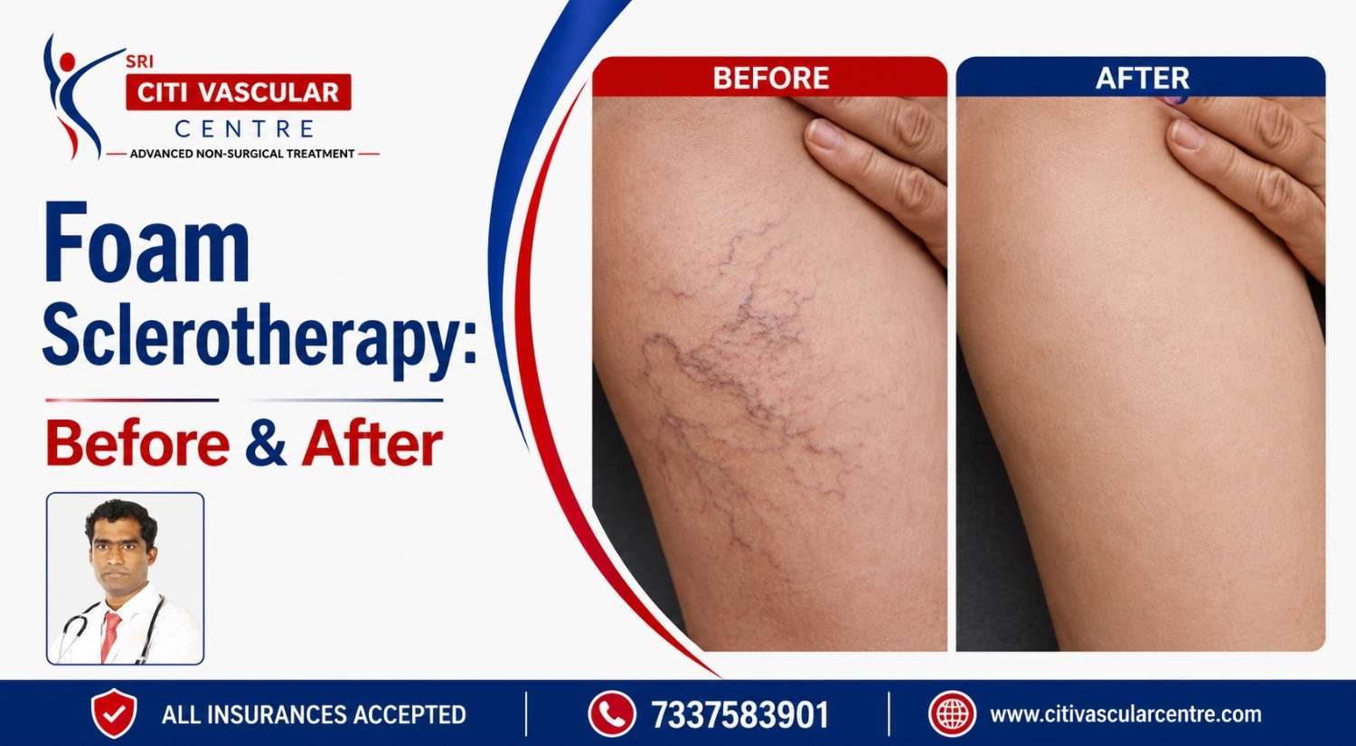 Dr. Shaileshkumar Garge performing ultrasound-guided foam sclerotherapy injection treatment for varicose veins at Citi Vascular Hospital KPHB Colony Hyderabad 