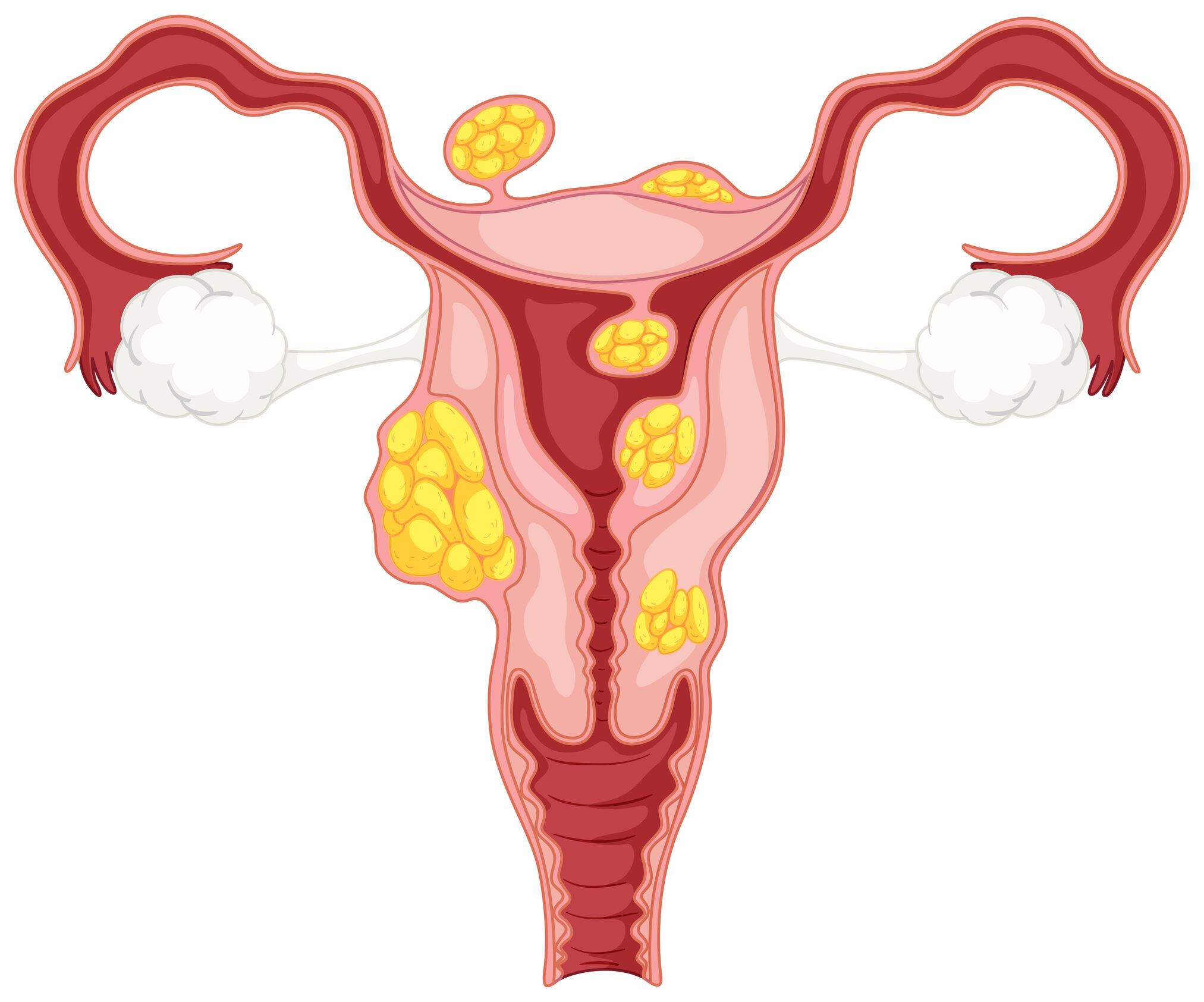 best diet for fibroids