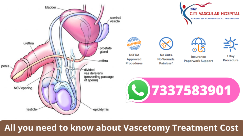 Vasectomy Treatment Cost in hyderabad