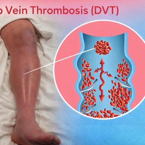 deep vein thrombosis specialist near me