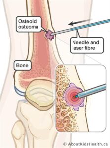 osteoid osteoma treatment radiology in hyderabad